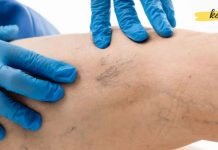 როგორ შევამციროთ ვარიკოზული ვენები ბუნებრივი საშუალებებით სახლის პირობებში?