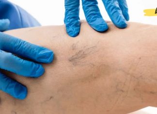 როგორ შევამციროთ ვარიკოზული ვენები ბუნებრივი საშუალებებით სახლის პირობებში?