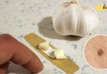 სოფლის მკურნალმა მირჩია, წებოვანი ლენტი და ნიორი დამედო მეჭეჭებზე. შედეგით აღფრთოვანებული ვარ! ის ძალიან სწრაფად გამიქრა!