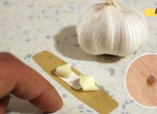 სოფლის მკურნალმა მირჩია, წებოვანი ლენტი და ნიორი დამედო მეჭეჭებზე. შედეგით აღფრთოვანებული ვარ! ის ძალიან სწრაფად გამიქრა!