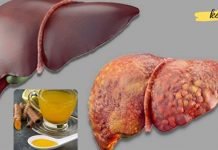 გაიწმინდეთ ღვიძლი ამ 7 ნატურალური პროდუქტით. ამის შემდეგ თქვენი ღვიძლი დაიწყებს იდეალურად მუშაობას..