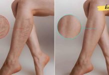 ყველაზე იაფი და მარტივი მეთოდი ვარიკოზული ვენების გასაქრობად!