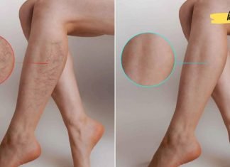 ყველაზე იაფი და მარტივი მეთოდი ვარიკოზული ვენების გასაქრობად!
