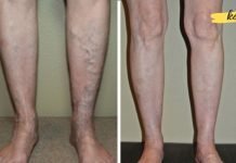 ეს ხალხური მეთოდებია ვენების სამკურნალოდ, რომლებიც ძალიან ეფექტურია!