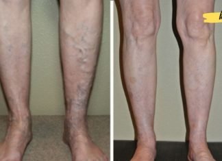 ეს ხალხური მეთოდებია ვენების სამკურნალოდ, რომლებიც ძალიან ეფექტურია!
