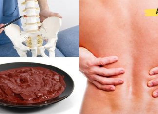 თქვენ შეძლებთ მოიცილოთ თიაქარი სახლის პირობებში, თუ ამ ნარევს წაისვამთ