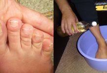 თუ ფეხებს ვაშლის ძმარში ჩააწყობთ, ფრჩხილის სოკო სწრაფად გაგიქრებათ. ეს თუ ასე ეფექტური იყო არც ვიცოდი!