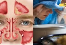 საუკეთესო რეცეპტები ჰაიმორიტის სამკურნალოდ! წაიკითხეთ, ეს აუცილებლად დაგეხმარებათ!