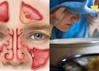 საუკეთესო რეცეპტები ჰაიმორიტის სამკურნალოდ! წაიკითხეთ, ეს აუცილებლად დაგეხმარებათ!