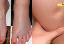 მოიშორეთ შეშუპების პრობლემა! ეს 9 მეთოდი დაგეხმარებათ ორგანიზმიდან ზედმეტი სითხის გამოდევნაში