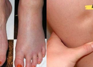 მოიშორეთ შეშუპების პრობლემა! ეს 9 მეთოდი დაგეხმარებათ ორგანიზმიდან ზედმეტი სითხის გამოდევნაში