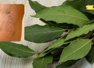 გამოიყენეთ დაფნის ფოთოლი ვარიკოზული ვენების გაგანიერების სამკურნალოდ! სასარგებლო რეცეპტი ხალხური მედიცინის წიგნიდან