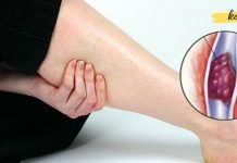 უხილავი და მომაკვდინებელი: როგორ გავიგოთ, გაქვთ თუ არა თრომბები