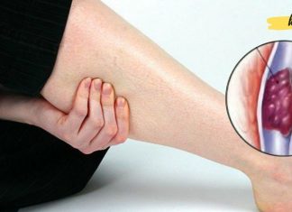 უხილავი და მომაკვდინებელი: როგორ გავიგოთ, გაქვთ თუ არა თრომბები