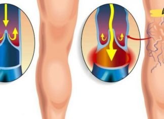 დალიეთ მცენარეული ჩაი ფეხებში სისხლის მიმოქცევის გასაუმჯობესებლად