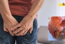 როგორ მოვირჩინოთ ბუასილი სწრაფად და უმტკივნეულოდ? ამაში ხალხური მედიცინა დაგვეხმარება