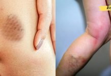 სისხლის შედედების სიმპტომები: როგორ გავიგოთ, გვაქვს თუ არა სისხლის შედედება?