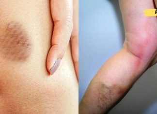 სისხლის შედედების სიმპტომები: როგორ გავიგოთ, გვაქვს თუ არა სისხლის შედედება?