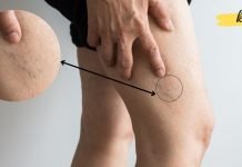 ეს 8 პროდუქტი ათხელებს სისხლს და ახდენს თრომბოზის პროფილაქტიკას.