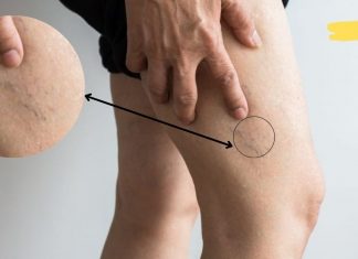 ეს 8 პროდუქტი ათხელებს სისხლს და ახდენს თრომბოზის პროფილაქტიკას.