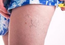 ეს ტრადიციული მედიცინის რეცეპტებია, რომლებიც დაგეხმარებათ ვარიკოზული ვენების მოცილებაში