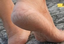 გააკეთეთ სახლის პილინგი, რომელიც შეგიმსუბუქებთ ქუსლების ტკივილს