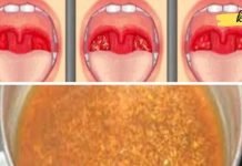 გაწუხებთ ყელის ტკივილი? გამოიყენეთ ეს ბუნებრივი საშუალება, რომელიც სწრაფად გაგათავისუფლებთ ტკივილისგან