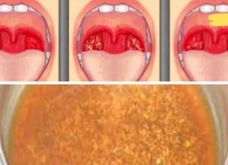 გაწუხებთ ყელის ტკივილი? გამოიყენეთ ეს ბუნებრივი საშუალება, რომელიც სწრაფად გაგათავისუფლებთ ტკივილისგან