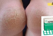 გამოიყენეთ ჩვეულებრივი ასპირინი ლამაზი ქუსლებისთვის. სცადეთ სახლის სამკურნალო საშუალება.