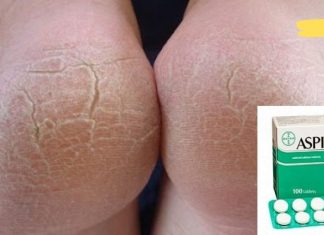 გამოიყენეთ ჩვეულებრივი ასპირინი ლამაზი ქუსლებისთვის. სცადეთ სახლის სამკურნალო საშუალება.