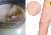 მეგობარმა გააკეთა ეს მალამო და წაისვა ვარიკოზულ ვენებზე. შედეგით გაოცებული დავრჩით ყველა! ის ნამდვილად მუშაობს!