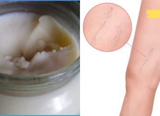 მეგობარმა გააკეთა ეს მალამო და წაისვა ვარიკოზულ ვენებზე. შედეგით გაოცებული დავრჩით ყველა! ის ნამდვილად მუშაობს!