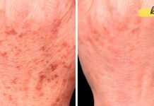 6 სასწაულებრივი საშუალება ასაკობრივ ლაქებთან საბრძოლველად. წარმოუდგენელი ეფექტი!