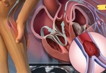 გაეცანით თრომბის ნიშნებს, რათა თავიდან აიცილოთ სასიცოცხლოდ მნიშვნელოვანი ორგანოებს გადაკეტვა. ამის ცოდნა აუცილებელია!