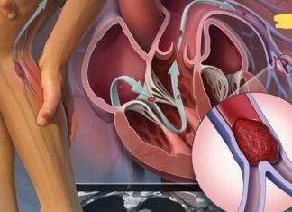 გაეცანით თრომბის ნიშნებს, რათა თავიდან აიცილოთ სასიცოცხლოდ მნიშვნელოვანი ორგანოებს გადაკეტვა. ამის ცოდნა აუცილებელია!