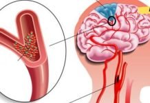 გაიწმინდეთ თავის ტვინის სისხლძარღვები ყველაზე ძლიერი რეცეპტით. ნაცადი მეთოდია