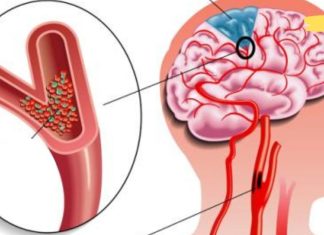 გაიწმინდეთ თავის ტვინის სისხლძარღვები ყველაზე ძლიერი რეცეპტით. ნაცადი მეთოდია
