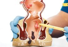 გაეცანით ბუასილის ყველაზე ეფექტურ სამკურნალო რეცეპტებს. შეგიმსუბუქებთ ტკივილს