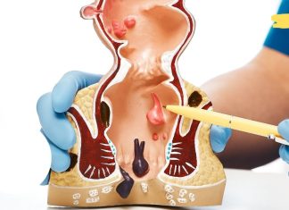 გაეცანით ბუასილის ყველაზე ეფექტურ სამკურნალო რეცეპტებს. შეგიმსუბუქებთ ტკივილს