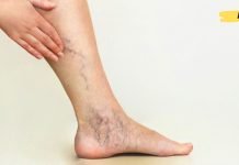 დედაჩემს დიდი ხნის განმავლობაში აწუხებდა ვარიკოზული ვენები. ბოლოს ეს რეცეპტი გამოიყენა და დაისვენა