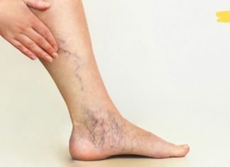 დედაჩემს დიდი ხნის განმავლობაში აწუხებდა ვარიკოზული ვენები. ბოლოს ეს რეცეპტი გამოიყენა და დაისვენა