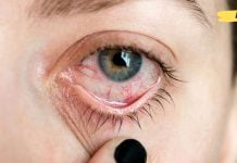 თვალის თეთრ გარსზე წითელი სისხლძარღვების გაჩენა გულის დაავადების ერთ-ერთი ნიშანია!. სამკურნალო რეცეპტები იხილეთ სტატიაში