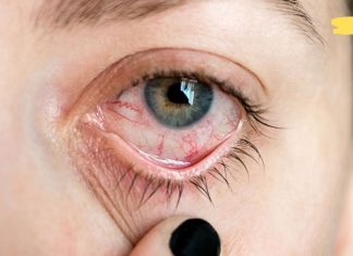 თვალის თეთრ გარსზე წითელი სისხლძარღვების გაჩენა გულის დაავადების ერთ-ერთი ნიშანია!. სამკურნალო რეცეპტები იხილეთ სტატიაში