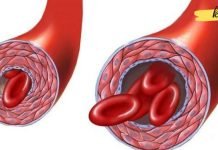 8 საკვები, რომელიც ამცირებს გაჯერებული ქოლესტერინის დონეს და აუმჯობესებს სისხლის მიმოქცევის ფუნქციას