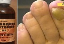 მოიშორე ფრჩხილის სოკო 2 კვირაში! სამკურნალო საშუალებები ხალხური მედიცინის წიგნაკიდან…