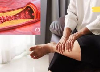 რა უნდა გავაკეთოთ ათეროსკლეროზის დროს? ეს რჩევები გამოგადგებათ!