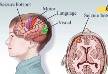 ხალხური მედიცინის ეფექტი ეპილეფსიაზე. ეს უნდა იცოდეთ!