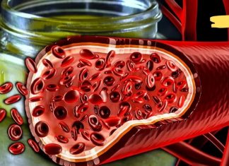 აი როგორ უნდა გავასუფთავოთ ქოლესტერინი სისხლძარღვებიდან 40 დღეში