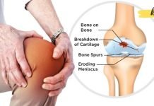 ძველი ინდური მედიცინა სახსრების ტკივილის შესამცირებლად გვთავაზობს ამ საშუალებებს! უნდა სცადოთ!