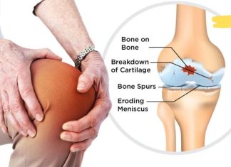 ძველი ინდური მედიცინა სახსრების ტკივილის შესამცირებლად გვთავაზობს ამ საშუალებებს! უნდა სცადოთ!